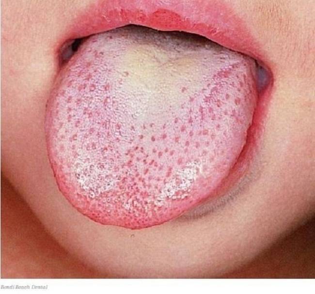 8 Sinais que sua língua dá e que podem dizer bastante sobre a sua saúde 38