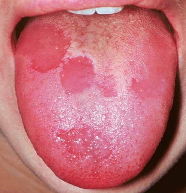 8 Sinais que sua língua dá e que podem dizer bastante sobre a sua saúde 34