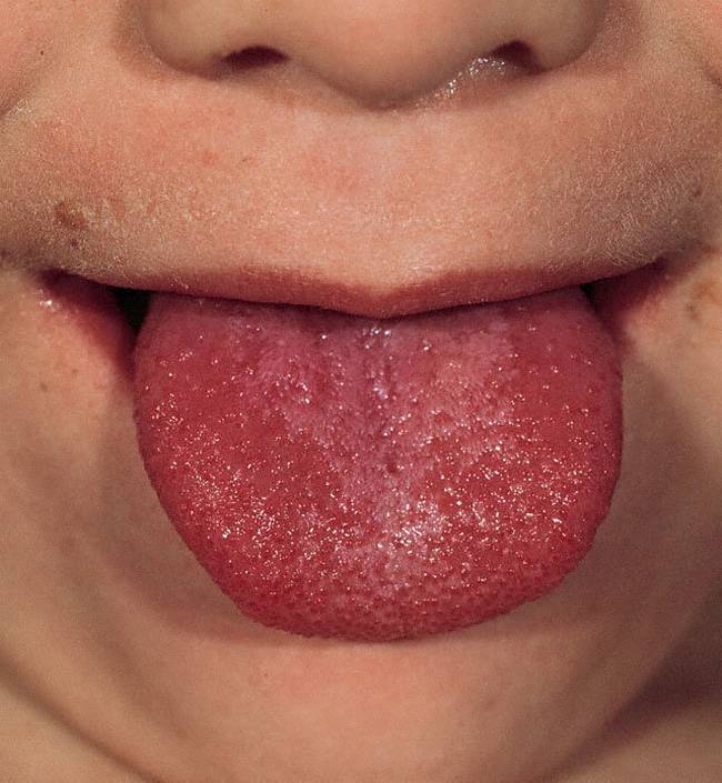 8 Sinais que sua língua dá e que podem dizer bastante sobre a sua saúde 35