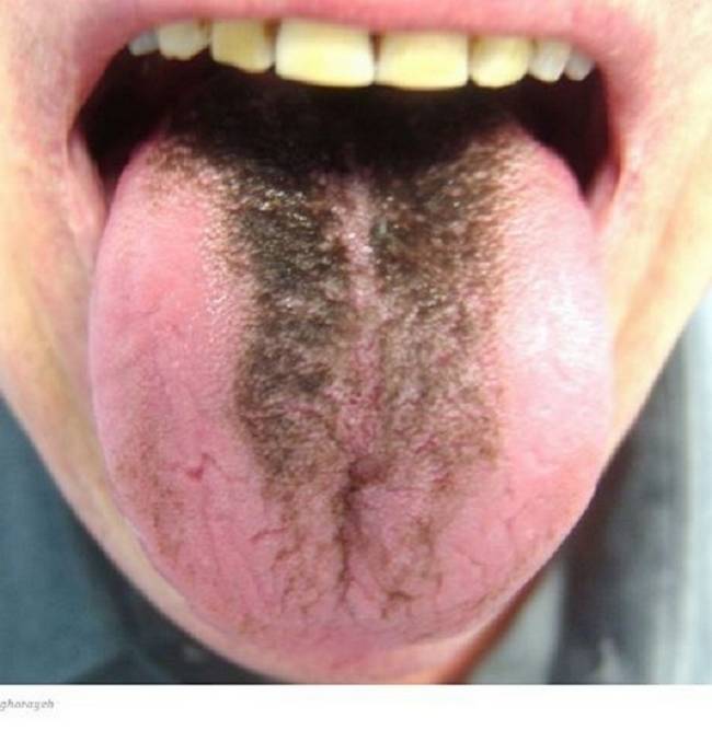 8 Sinais que sua língua dá e que podem dizer bastante sobre a sua saúde 37