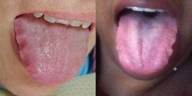 8 Sinais que sua língua dá e que podem dizer bastante sobre a sua saúde 43