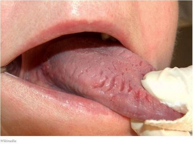 8 Sinais que sua língua dá e que podem dizer bastante sobre a sua saúde 44