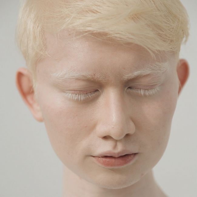 Albinismo ao redor do mundo